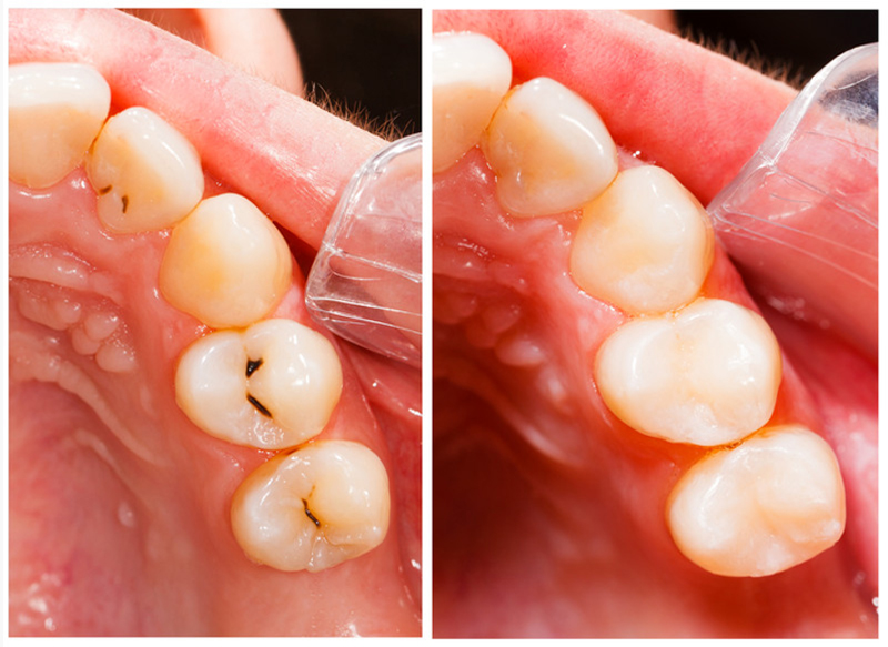 Fillings in Fort Worth | Keller Crossing Dentistry