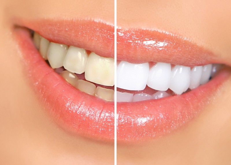 Teeth Whitening Fort Worth, TX
